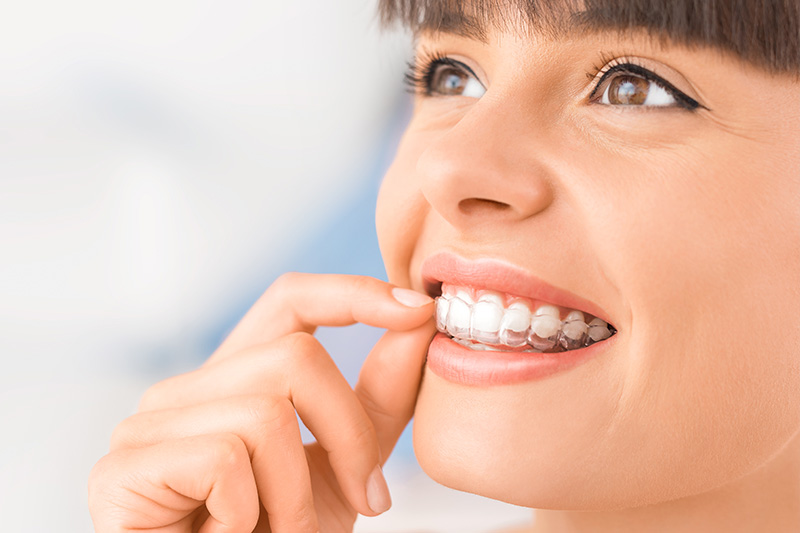 Clear Aligners in Chicago